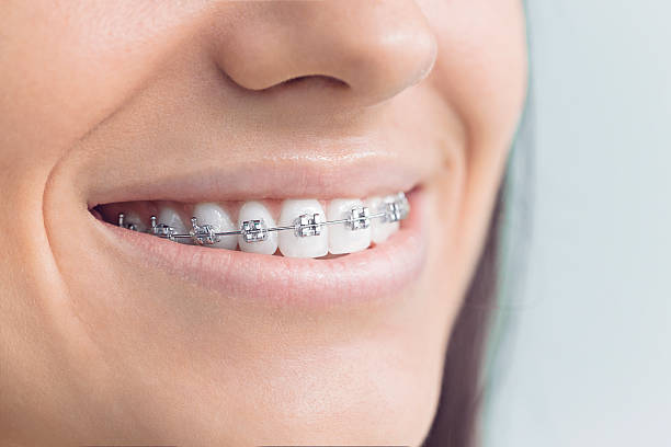 Best Veneers and Lumineers  in Dana Point, CA